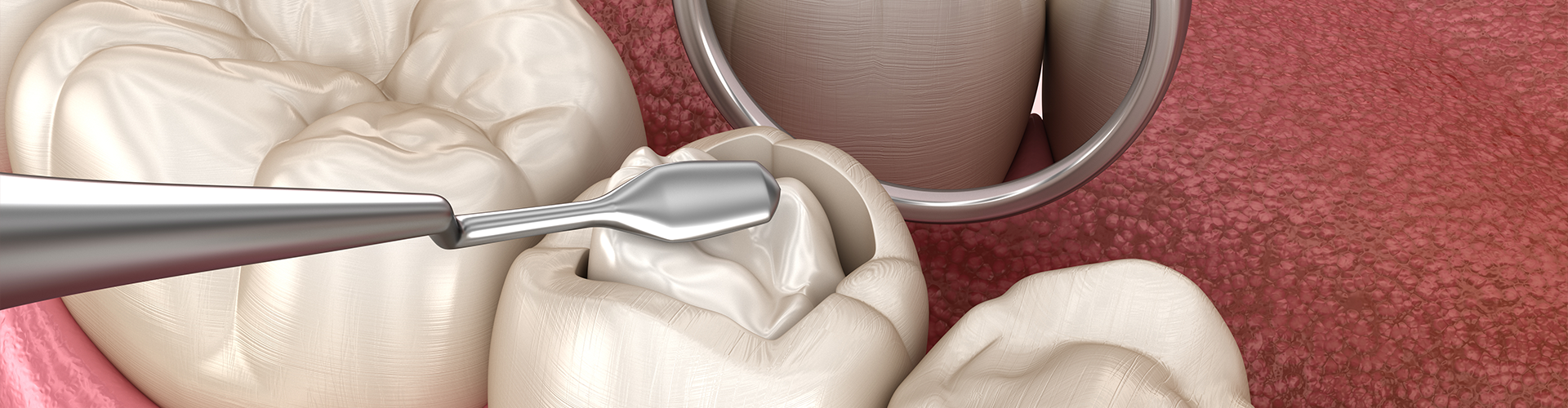 dental tool pressing white material into hole in tooth.